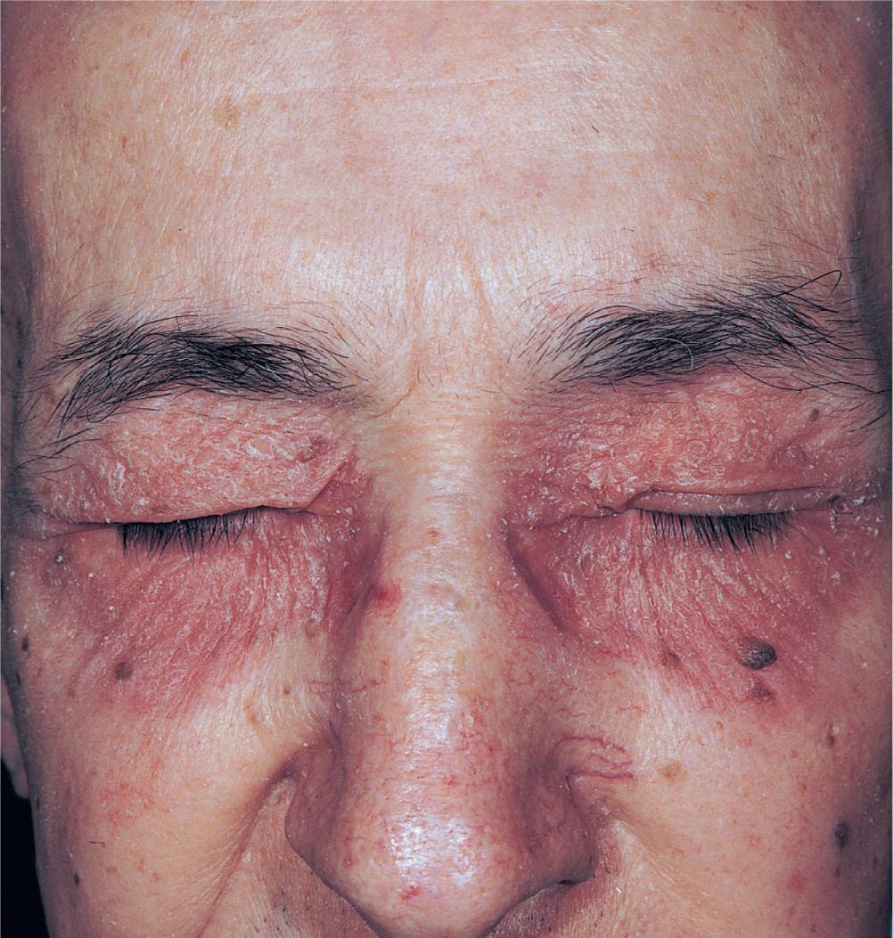 FIG 3.15, Subacute and chronic eczema. Dermatitis of the lids may be allergic, irritant, or atopic in origin. This atopic patient rubs the lids with the back of the hands.