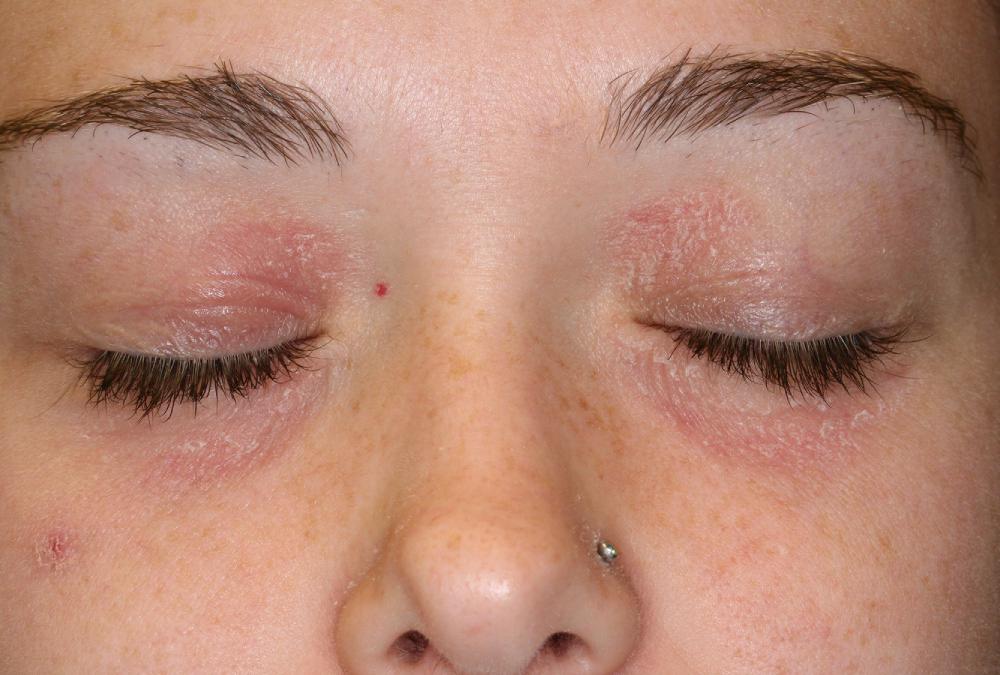 FIG 3.16, Chronic eczematous inflammation on the eyelid should be treated with low strength corticosteroids such as desonide. When the rash resolves, bland emollients such as petrolatum should be applied, especially at night. Patch testing should be performed for patients with persistent dermatitis.