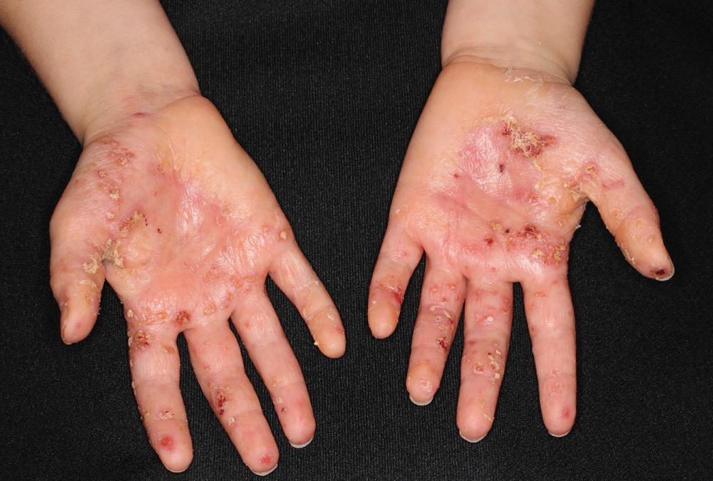 FIG 3.17, Patients with palmar pustulosis should be cultured for bacteria and fungi. Bacterial culture showed abundant Staphylococcus aureus . This rash resolved with 1 week of cephalexin and twice daily application of mometosone ointment.