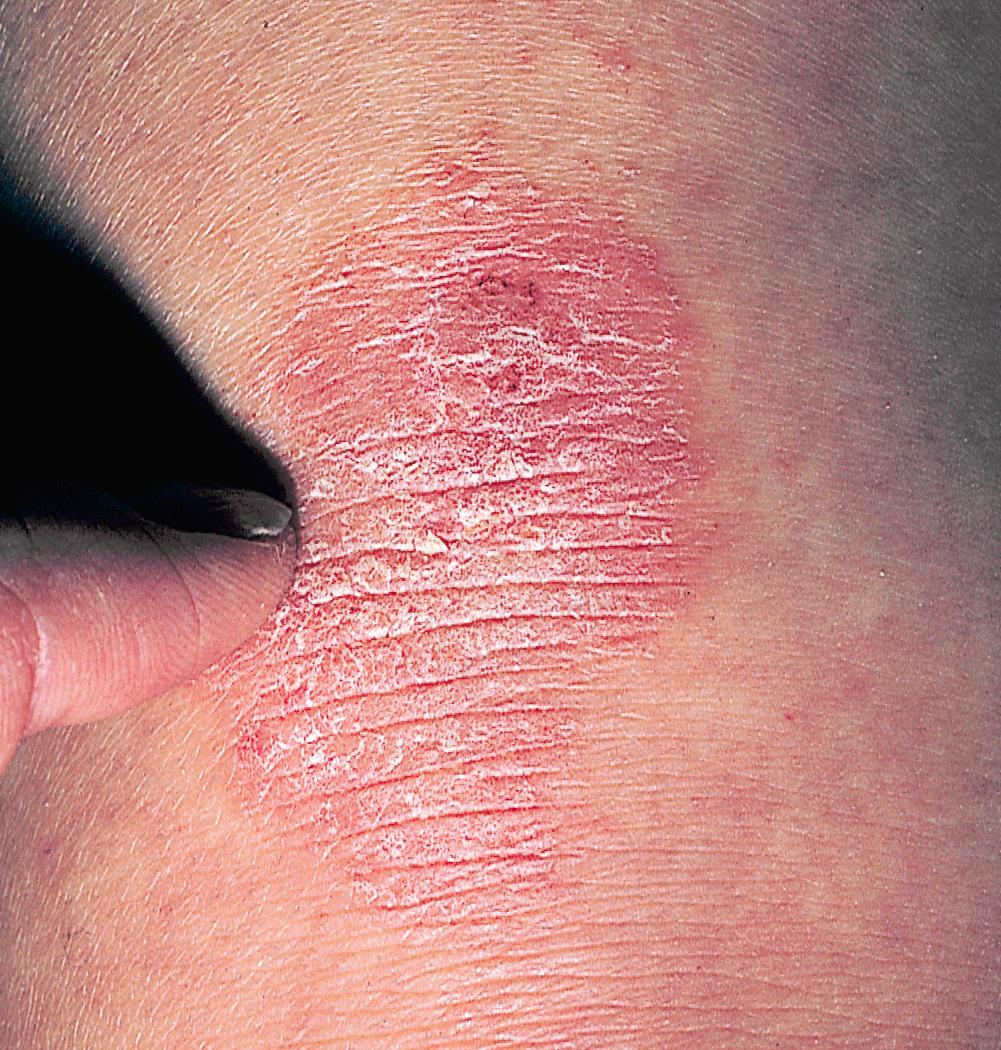 FIG 3.18, Chronic eczematous inflammation. Chronic excoriations thicken the epidermis, which results in accentuated skin lines. Chronic eczema created by picking is called lichen simplex chronicus.