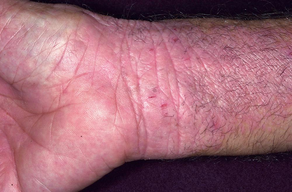 FIG 3.20, Chronic eczematous inflammation. Atopic dermatitis is common in the crease areas. Atopic patients scratch and lichenify the skin and often create a chronic process.