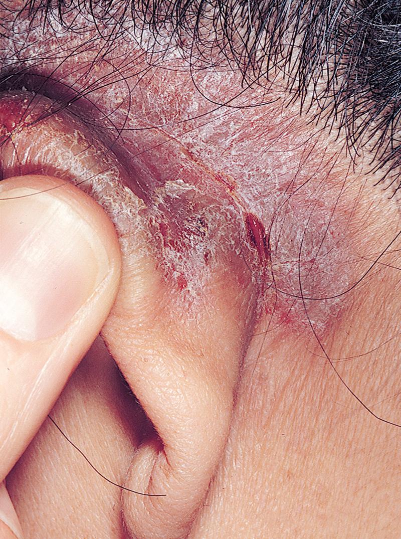 FIG 3.21, Chronic eczematous inflammation. Picking and rubbing thickened the skin behind the ear.