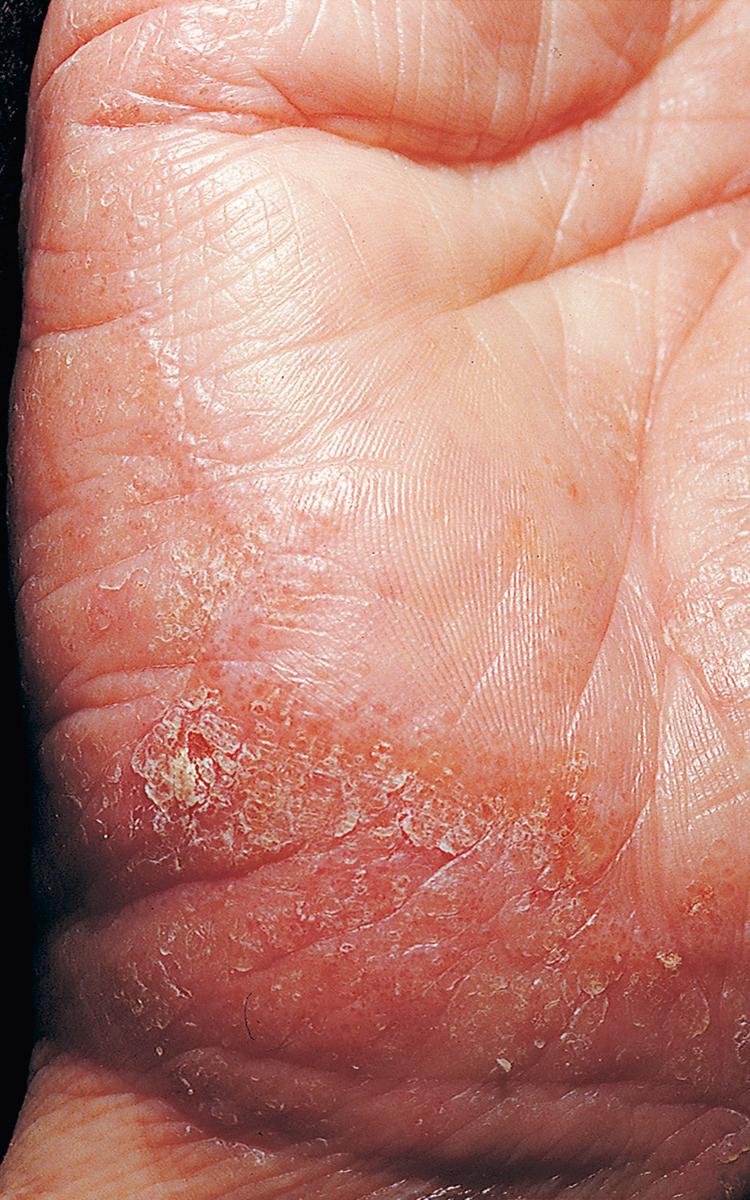 FIG 3.2, Acute eczematous inflammation. Vesicles appeared during a 24-hour period in this patient with chronic hand eczema. Episodes of acute inflammation had occurred several times in the past.