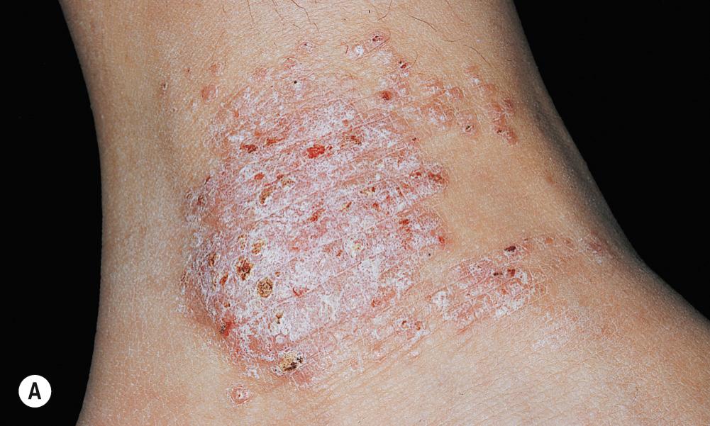 FIG 3.22, Chronic eczematous inflammation. A, A plaque of lichen simplex chronicus created by excoriation is present. B, Accentuated skin lines differentiate this process from psoriasis.