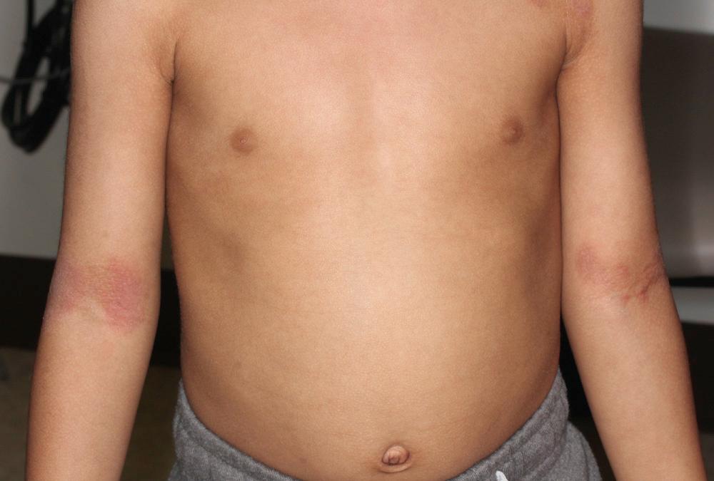 FIG 3.23, Atopic dermatitis involving the antecubital fossa.