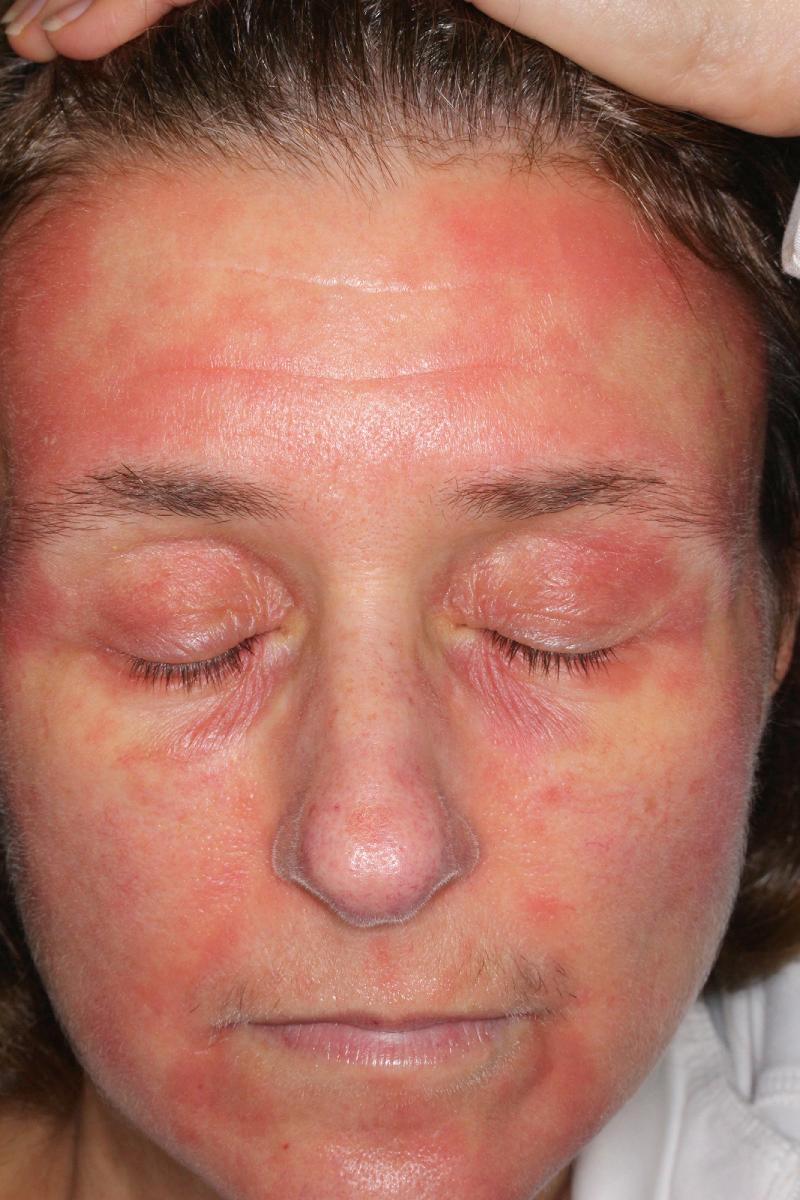 FIG 3.24, Eczematous dermatitis. Patients with long-standing facial and neck dermatitis sometimes respond to oral antifungal agents such as oral itraconazole or fluconazole.