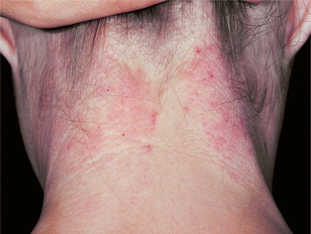 FIG 3.19, Chronic eczematous inflammation. Erythema and scaling are present, and the skin lines are accentuated, creating a lichenified or “washboard” lesion.