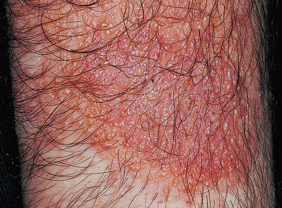 FIG 3.3, Acute eczematous inflammation. Numerous vesicles occurred after exposure to poison ivy.