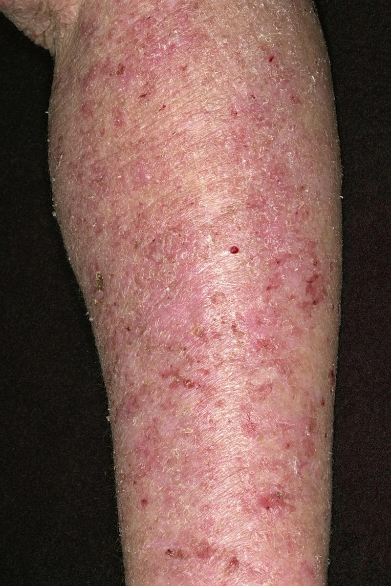 FIG 3.6, Subacute eczema. Diffuse redness and scaling of the entire forearm in a patient with generalized atopic dermatitis.