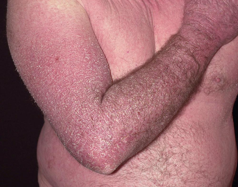 FIG 3.7, Subacute eczema. Erythema and scaling are present, the surface is dry, and the borders are indistinct.