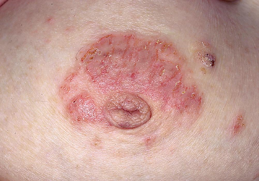 FIG 3.8, Subacute eczema. The areolae of both breasts are red and scaly. Inflammation of one areola is characteristic of Paget disease.