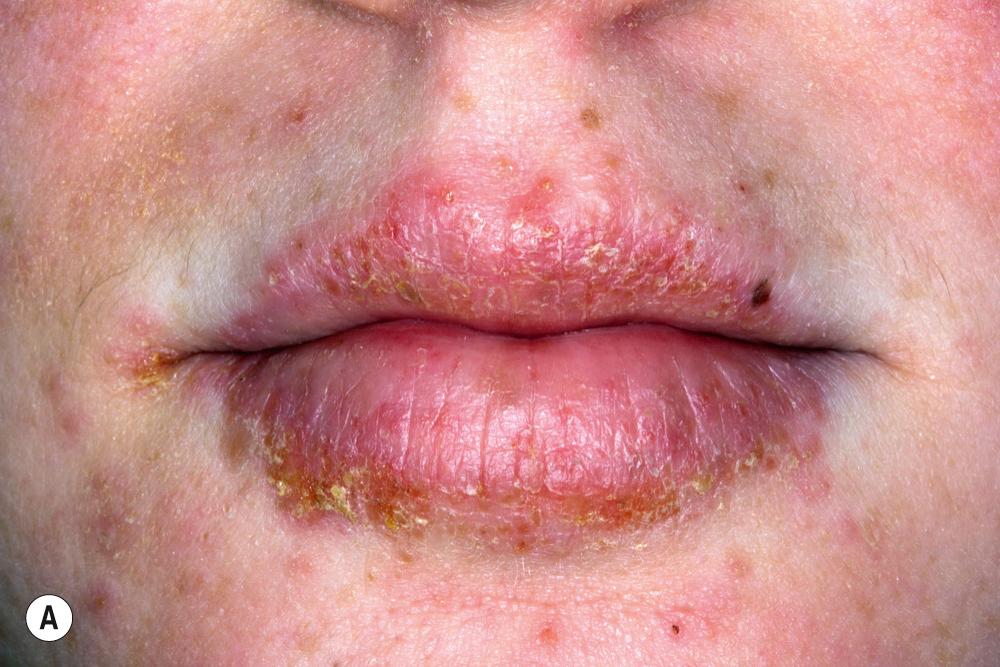 FIG 3.9, Subacute eczema. A–B, Wetting the lip by licking will eventually cause chapping and then eczema.