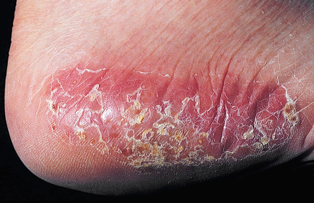 FIG 3.10, Eczema resembling psoriasis. Acute and subacute eczematous inflammation. Acute vesicular eczema is evolving into subacute eczema. Vesicles, redness, and scaling are all present in this lesion undergoing transition.