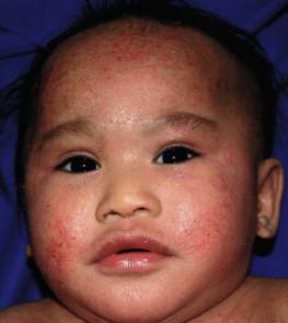 Figure 15.1, Atopic dermatitis with typical early facial involvement.