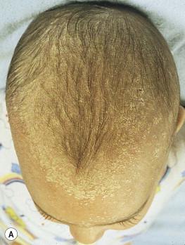 Figure 15.3, (A) Scalp scaling (akin to ‘cradle cap’) may be the first manifestation of atopic dermatitis. (B) Temporary alopecia may result from rubbing the sides of the head against the bedding to alleviate itching.