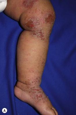 Figure 15.4, (A) Extensor involvement with lichenification and crusting of the leg. (B) Erythema, scale, and crust on the extensor surface of the arm.