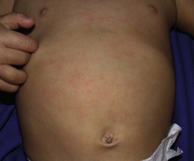 Figure 15.5, Truncal atopic dermatitis with erythema, papules, and mild scaling.