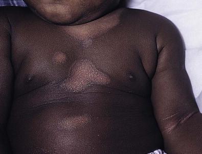 Figure 15.8, Marked postinflammatory hypopigmentation from AD lesions, which is common in darkly pigmented infants.