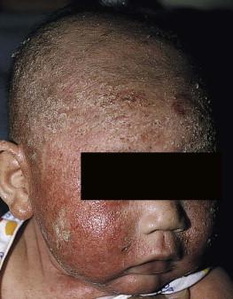 Figure 15.9, It can be difficult to distinguish seborrheic dermatitis from atopic dermatitis in young infants, but over time the diagnosis becomes evident given greater persistence and pruritus with AD (which this child developed).