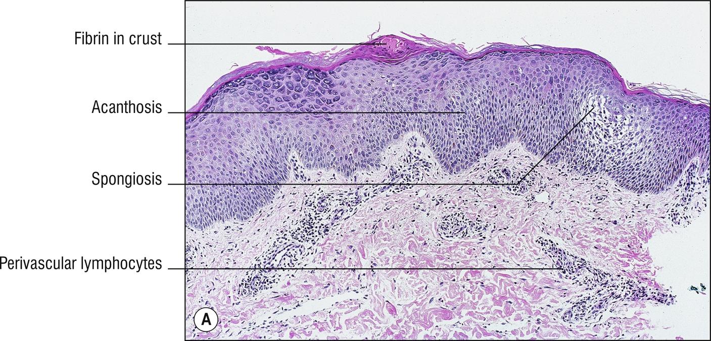 Fig. 2.1, A Eczema (low power).