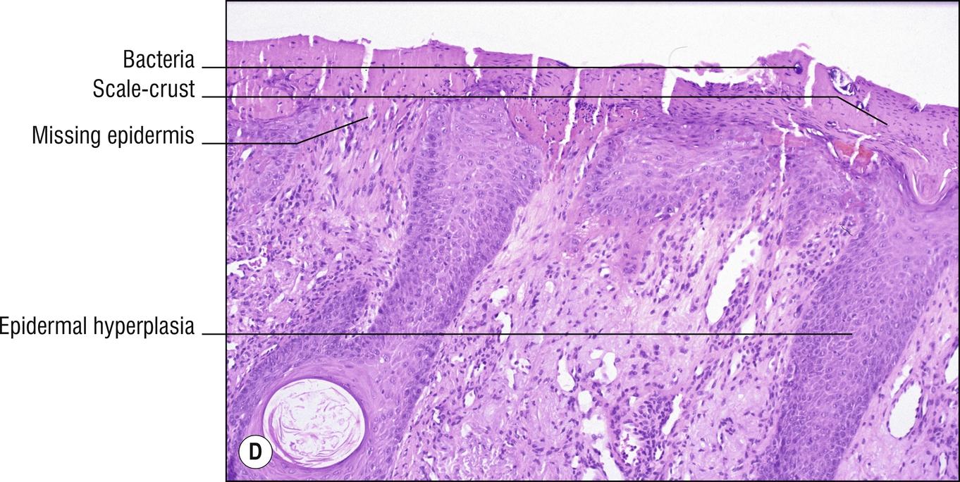 Fig. 2.3, D Trigeminal trophic syndrome. The surface of the epidermis is excoriated and there is epidermal hyperplasia from constant prurigo.