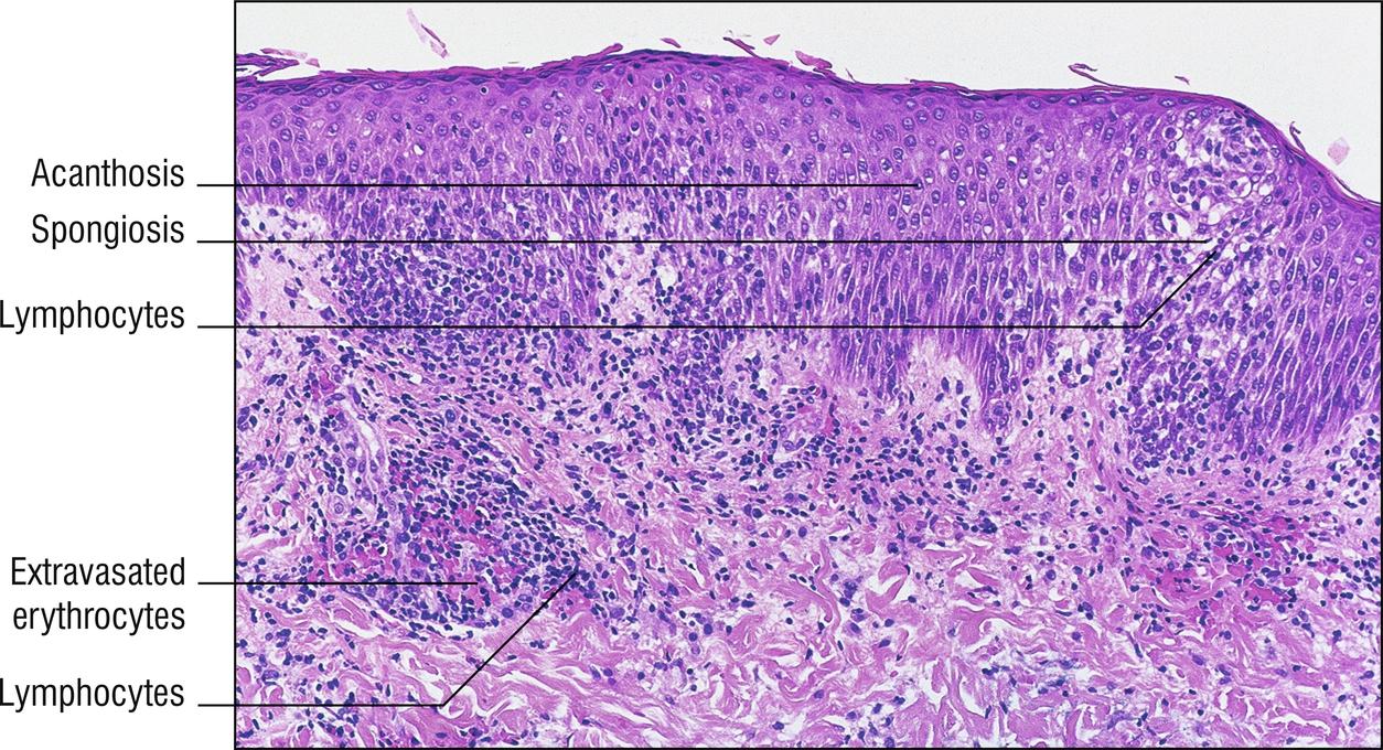 Fig. 2.4, Pityriasis rosea.