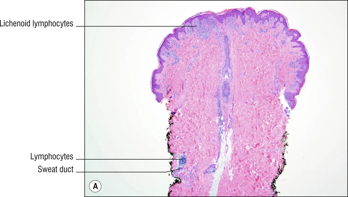 Fig. 2.5, A Lichen striatus (low mag.). B Lichen striatus (high mag.).