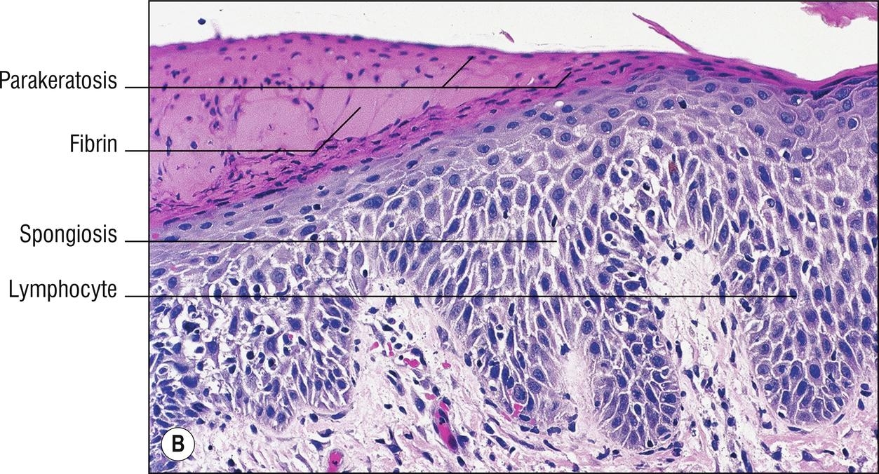 Fig. 2.1, B Eczema (medium power).