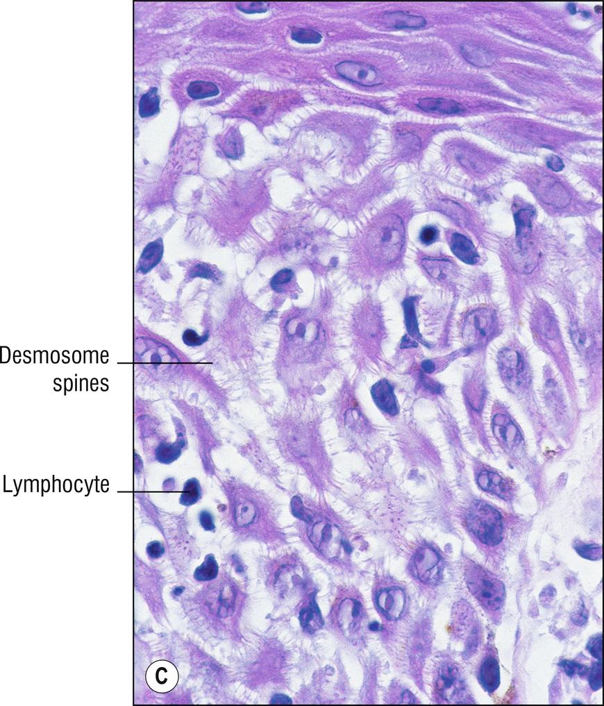 Fig. 2.1, C Eczema (high-power view of spongiosis).