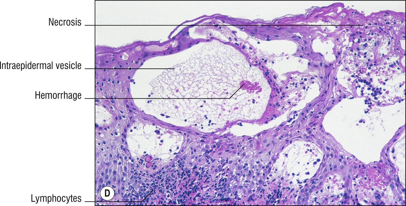 Fig. 2.1, D Vesicular eczema. Intraepidermal vesiculation or so-called reticular degeneration from severe spongiosis.