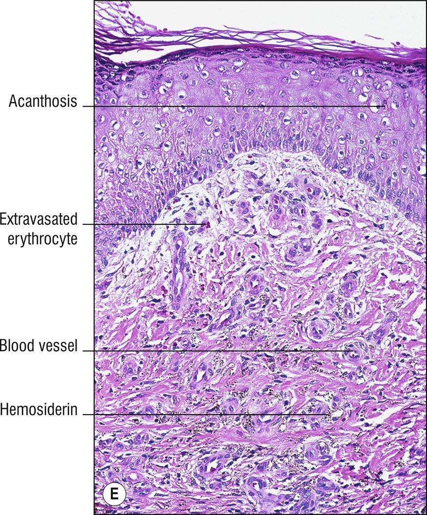 Fig. 2.1, E Stasis dermatitis.