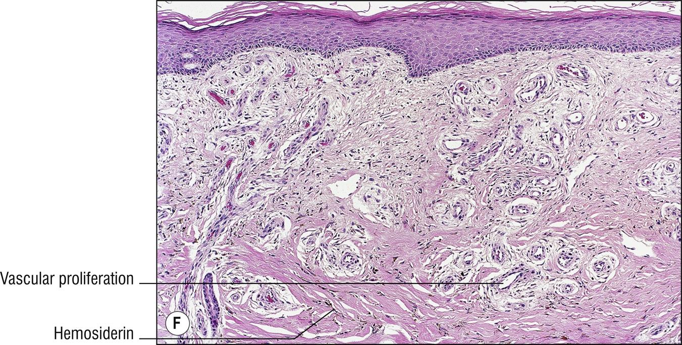 Fig. 2.1, F Acroangiodermatitis.