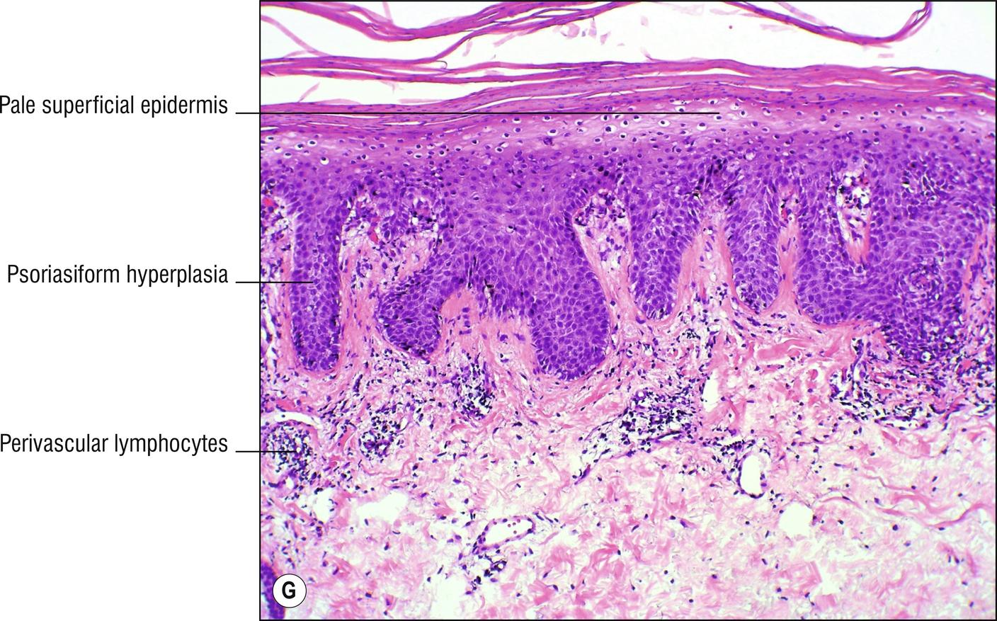 Fig. 2.1, G Pellagra.