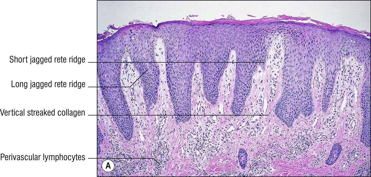 Fig. 2.3, A Lichen simplex chronicus (low mag.).