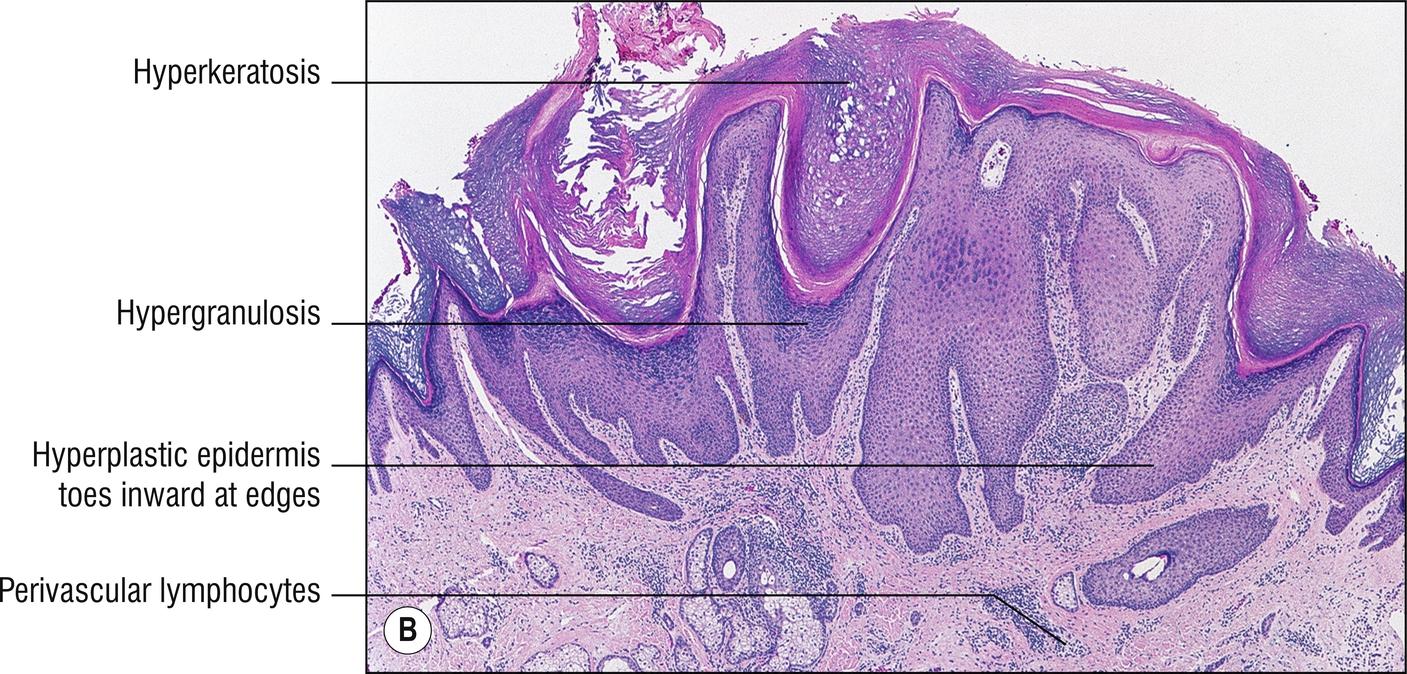 Fig. 2.3, B Prurigo nodularis.