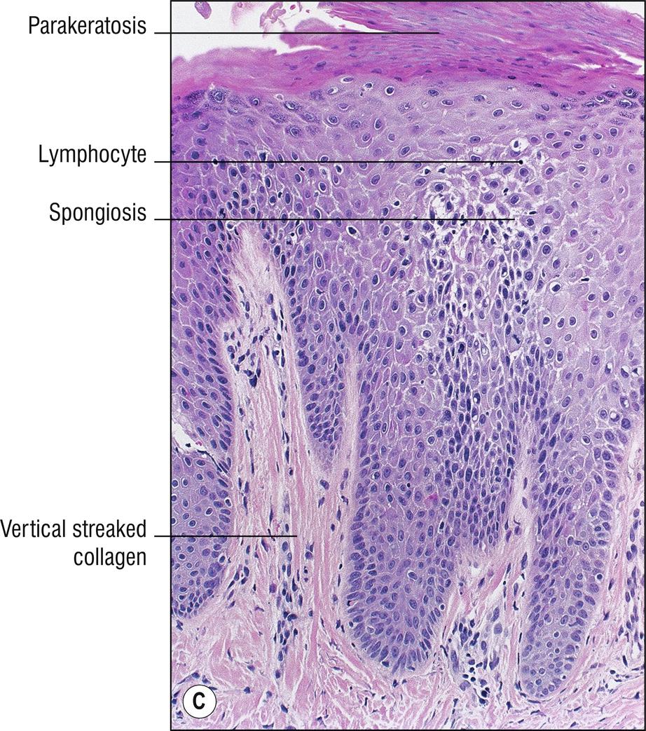 Fig. 2.3, C Lichen simplex chronicus (high mag.).