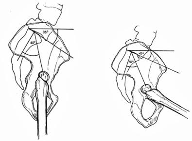 Fig. 75.1, Normal spine-pelvic-hip positions both standing (left) and sitting (right) . Standing has anterior tilt of the pelvis with lordosis of the spine and the sacral slope (SS) measurement being the angle of the S1 endplate and pelvic femoral angle (PFA), the angle of the femur to the pelvis. The acetabulum is relatively closed, with an opening of a mean of 35 degrees. Sitting, the pelvis tilts posteriorly and the SS flattens by a mean of 20 degrees, the PFA flexes by a mean of 60 degrees, and the acetabular opening is a mean of 55 degrees.