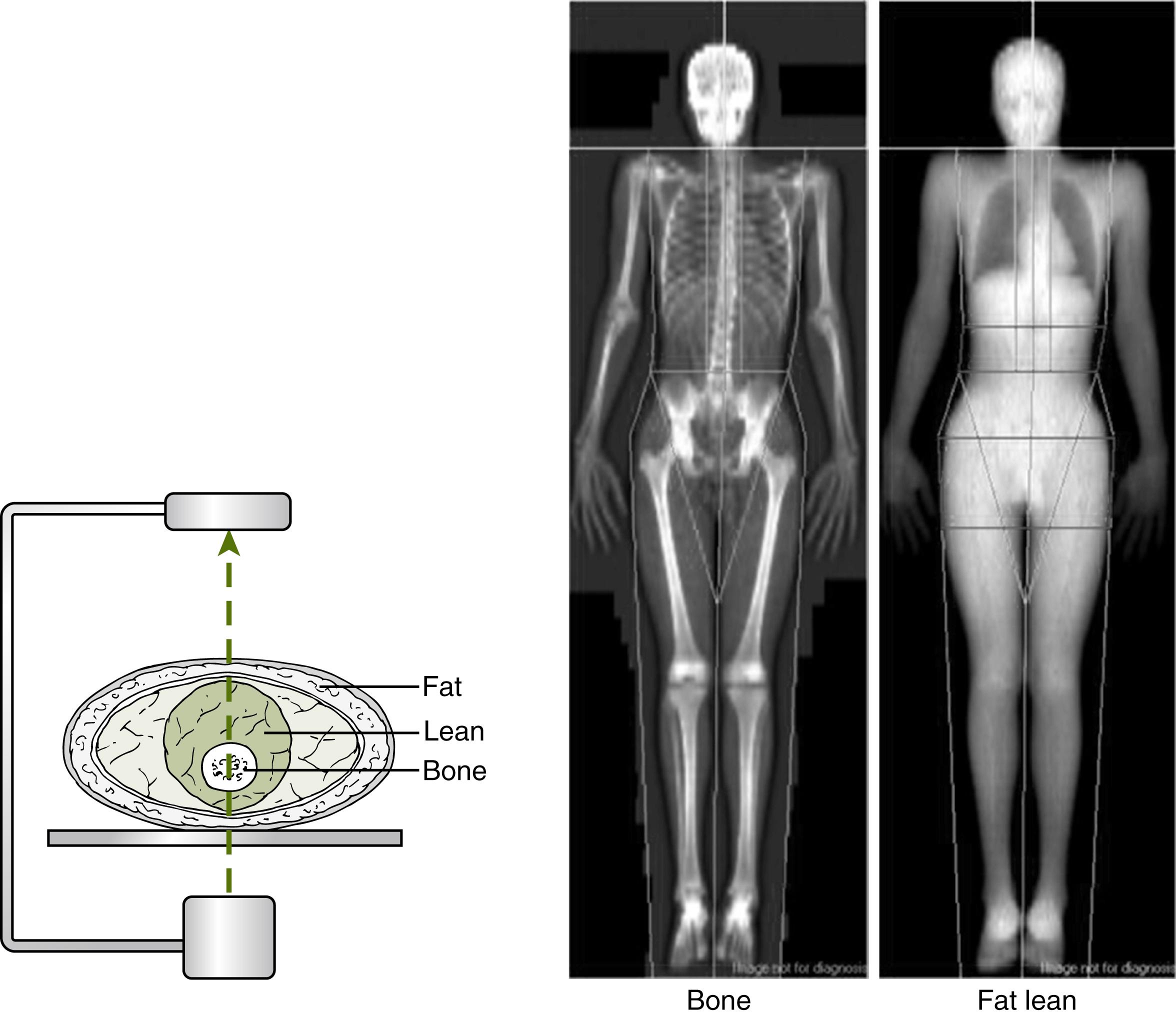 Fig. 91.2, Dual x-ray absorptiometry (DXA). Left: A DXA instrument scans the whole body with two x-ray beams of different energy emitted from a source under the subject. The detector array above the patient measures the attenuation of energy by different body tissues. Right: Computer software produces two-dimensional image of the skeleton and soft tissues. Tissue “density” is expressed as g/cm 2 and there is not a true volumetric density.