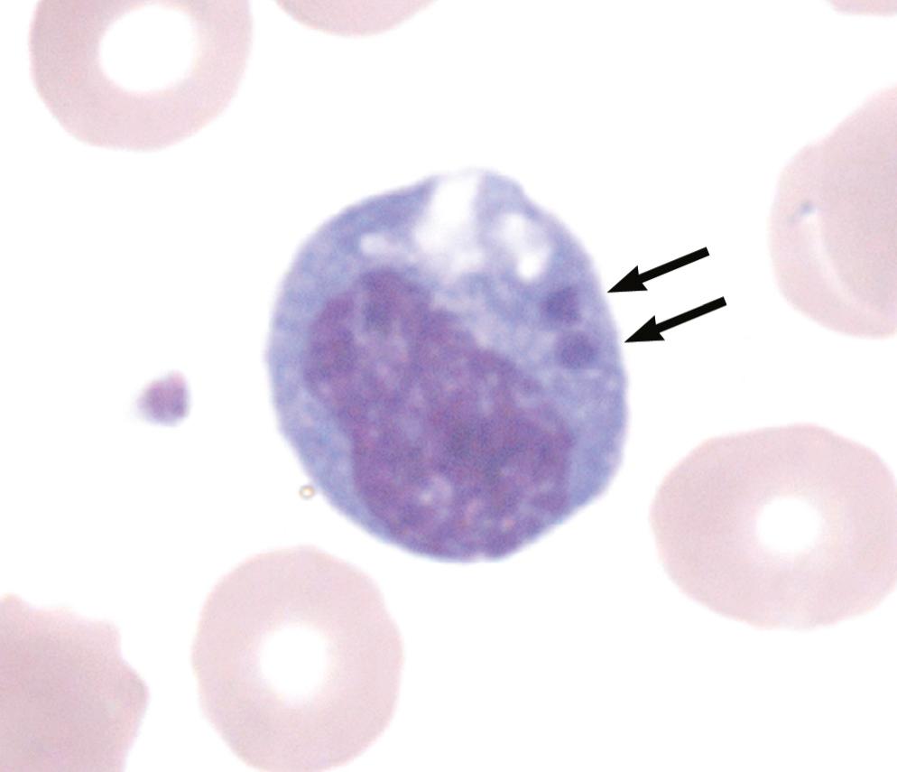 FIG. 192.1, Human monocytotropic ehrlichiosis.