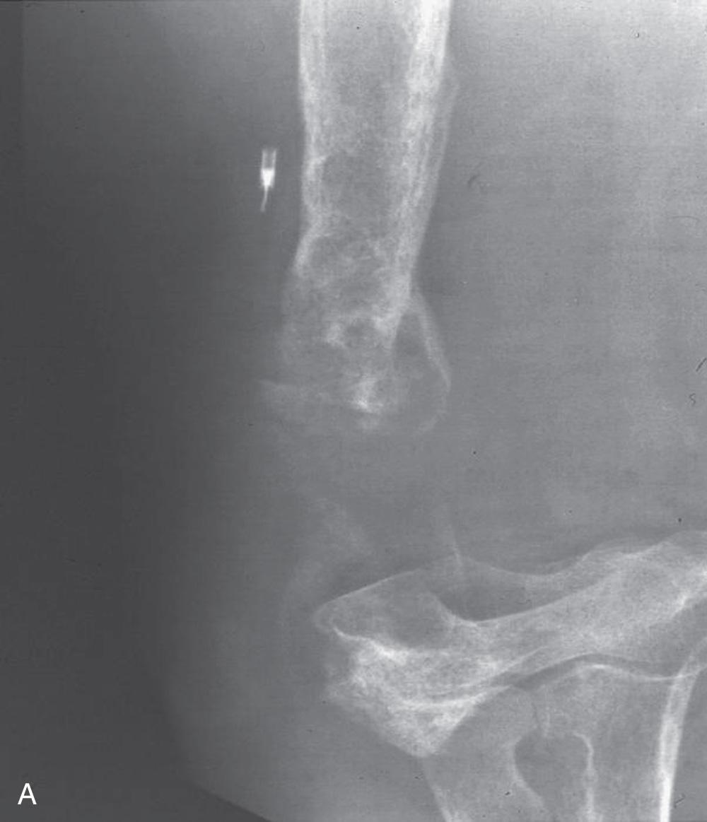 FIG 85.2, (A) Linked devices were used for devastating bone loss. (B–D) Various articular and design concepts were used.