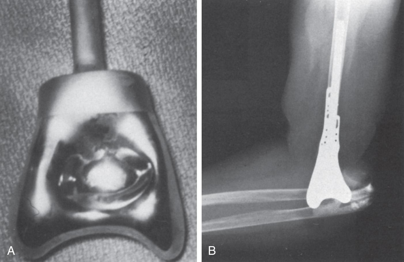 FIG 85.3, (A) Vitallium replacement prosthesis for the distal end of the humerus. Instability (B) and loosening (C) were common problems.