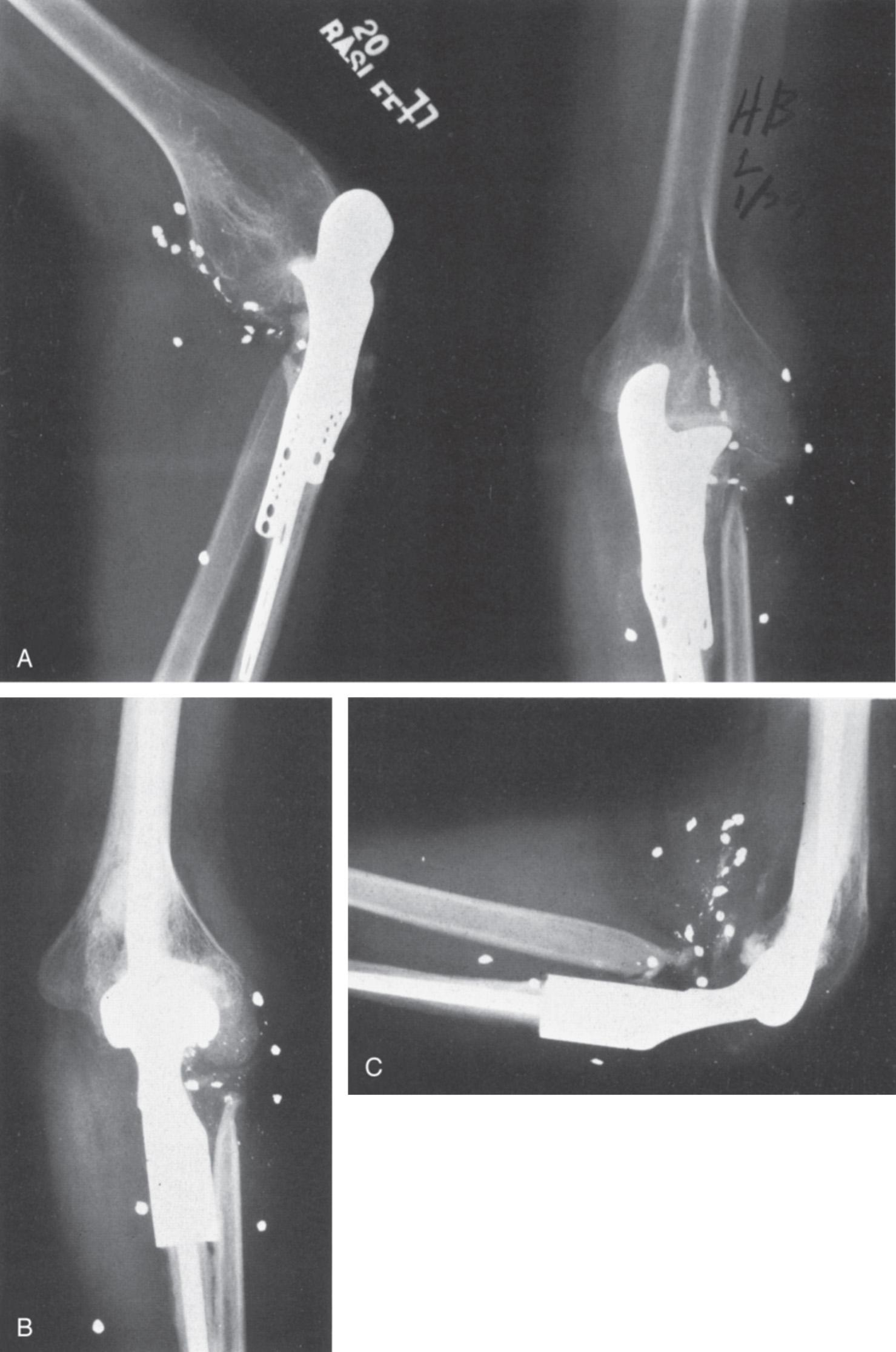 FIG 85.4, (A) Replacement prosthesis for the proximal end of the ulna (designed by E.W. Johnson and A.P. Schlein). The original replacement prosthesis lasted 13 years before requiring revision to a custom Mayo-modified Coonrad total elbow arthroplasty. (B,C) Custom total elbow revision replacement.