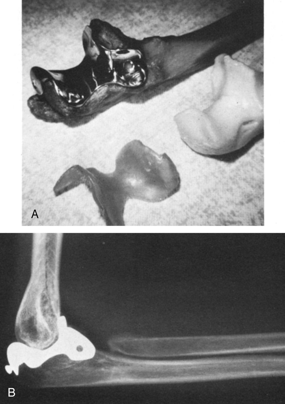 FIG 85.5, (A) A Vitallium “saddle” designed by Bickel and Peterson to resurface the proximal end of the ulna. (B) Fifteen-year follow-up of a patient with posttraumatic arthritis treated with the Vitallium saddle. There was mild pain and motion from 80 to 135 degrees.