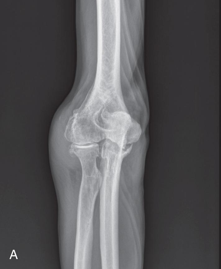 FIG 91.1, Elbow rheumatoid arthritis. (A) Anteroposterior view. (B) Lateral view.