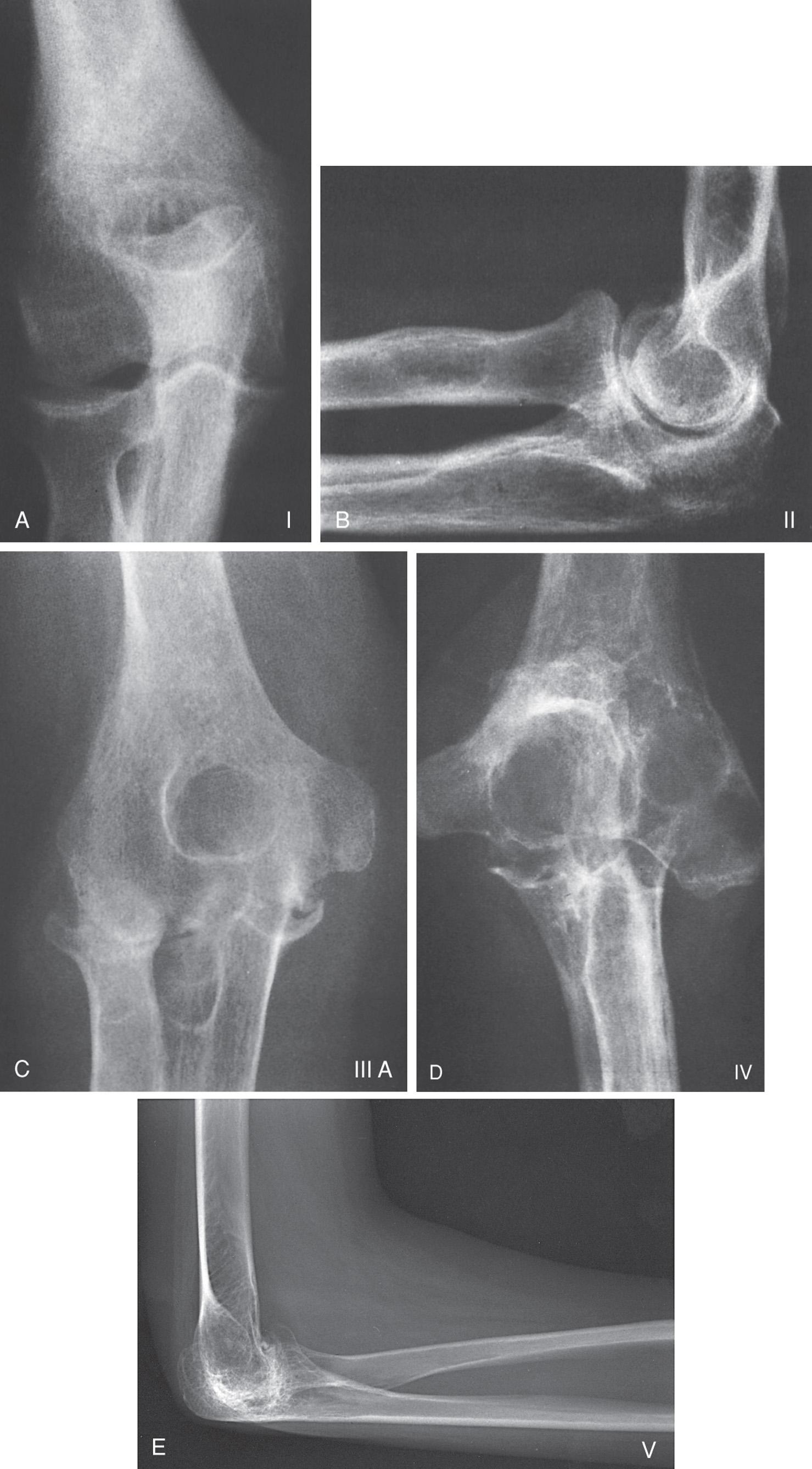 FIG 91.2, Mayo classification of elbow rheumatoid arthritis.