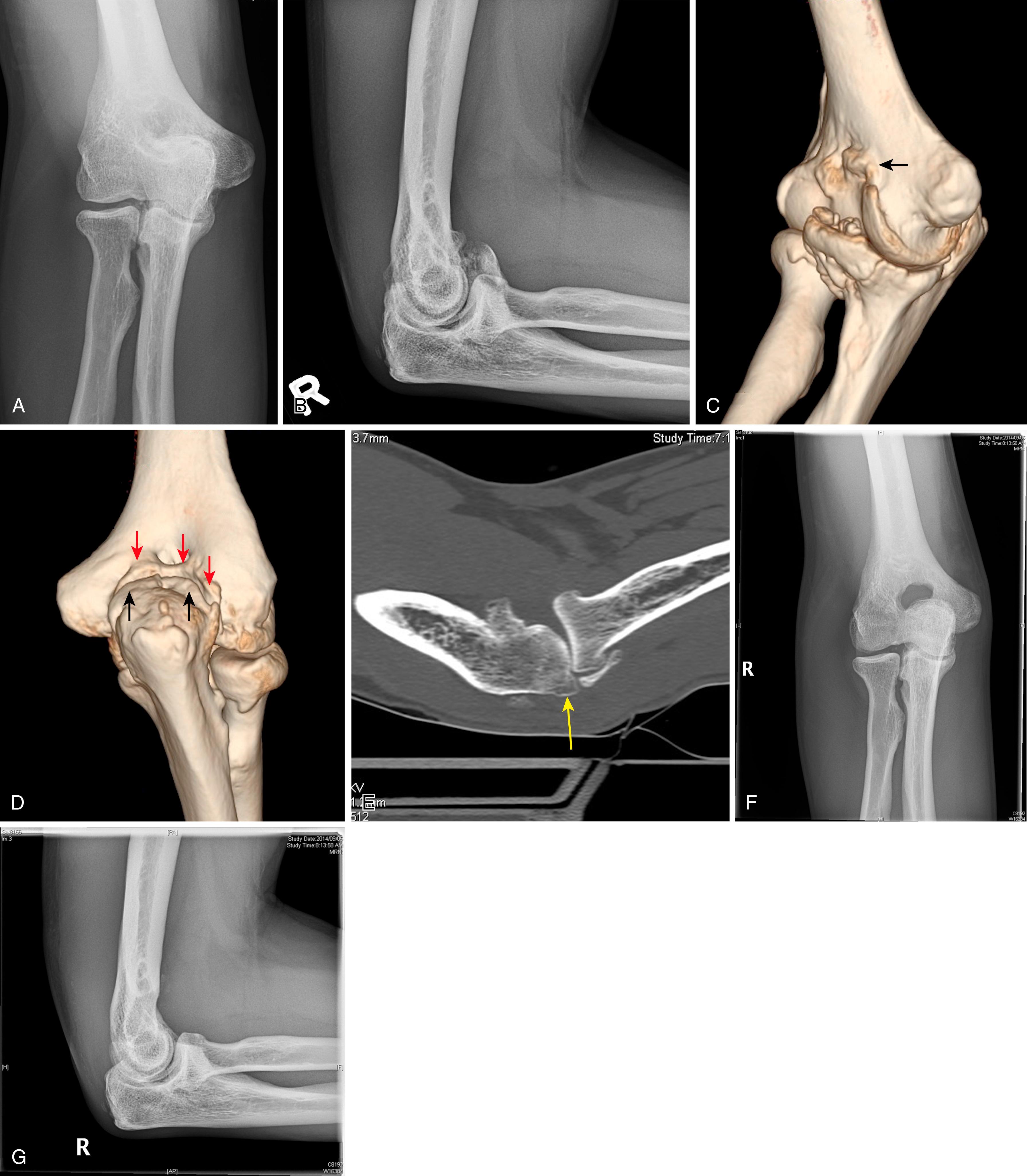 Fig. 26.1, Anteroposterior and lateral radiographs ( A and B ) of a 50-year-old male laborer with restricted elbow range of motion (45 degrees of extension to 100 degrees of flexion) and terminal impingement-related pain. A CT scan with 3D reconstructions (C) identifies osteophytes on the coronoid tip and within the radial and coronoid fossae (open black arrow) on the anterior humerus. A posterior view (D) of the olecranon identifies osteophytes on the medial and lateral aspects of the olecranon process (black arrows) , which are impinging against osteophytes in the olecranon fossa (red arrows) . In addition to osteophytes on the olecranon and in the olecranon fossa, restriction in extension may also be caused by osteophytes present on the posterior portion of the capitellum (yellow arrow) , which impinge against the radial head in extension (E) . After an arthroscopic debridement, olecranon fossa fenestration, and capsulectomy, as described in the Debridement for Osteoarthritis section (see Figs. 26.9, 26.10, and 26.11), the patient has functional range of motion with postoperative radiographs demonstrating osteophyte removal ( F and G ).