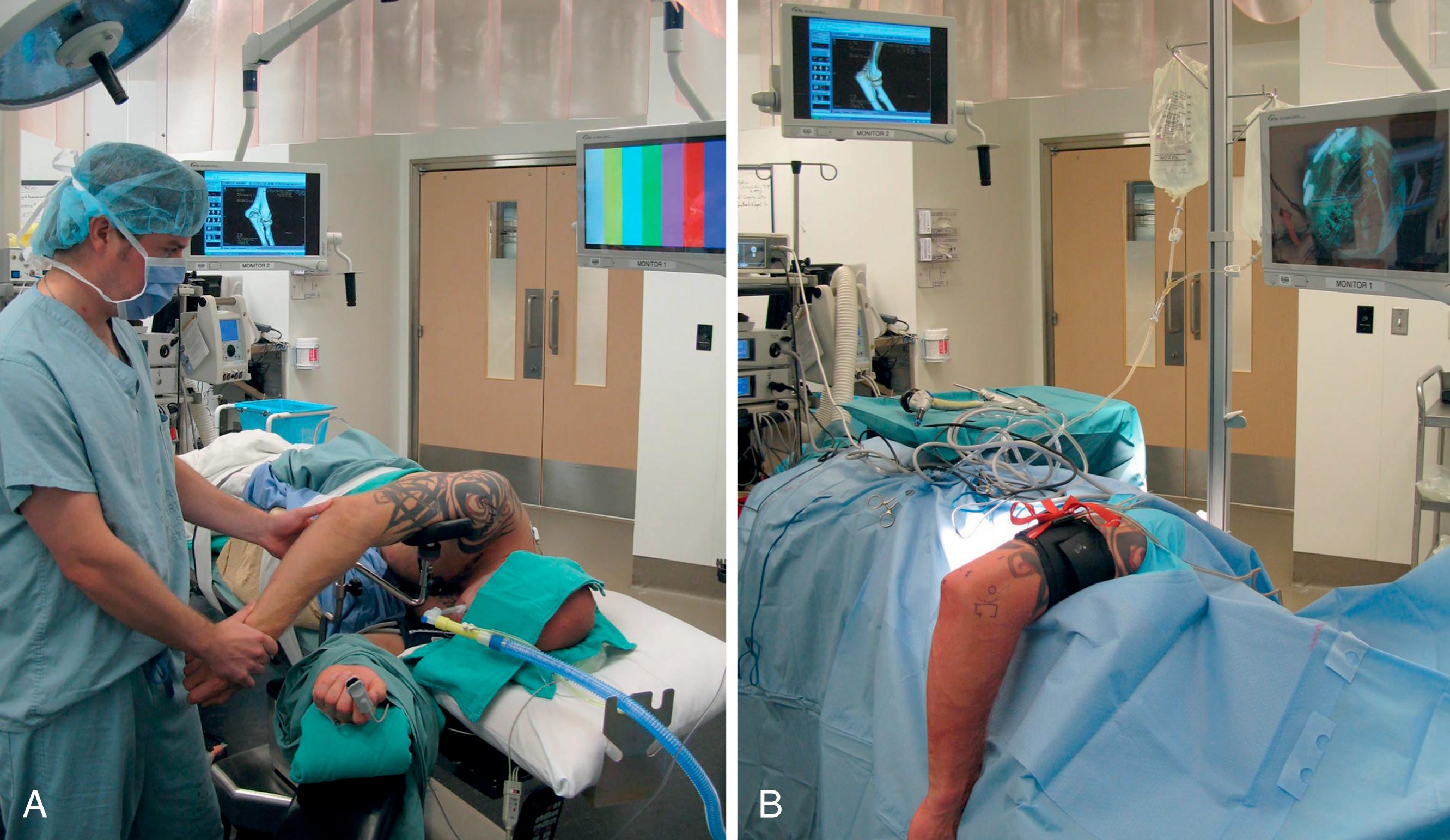 Fig. 26.3, Lateral positioning on a bean bag with use of an elbow positioning device prior to surgical preparation (A) and after preparation and draping (B) .