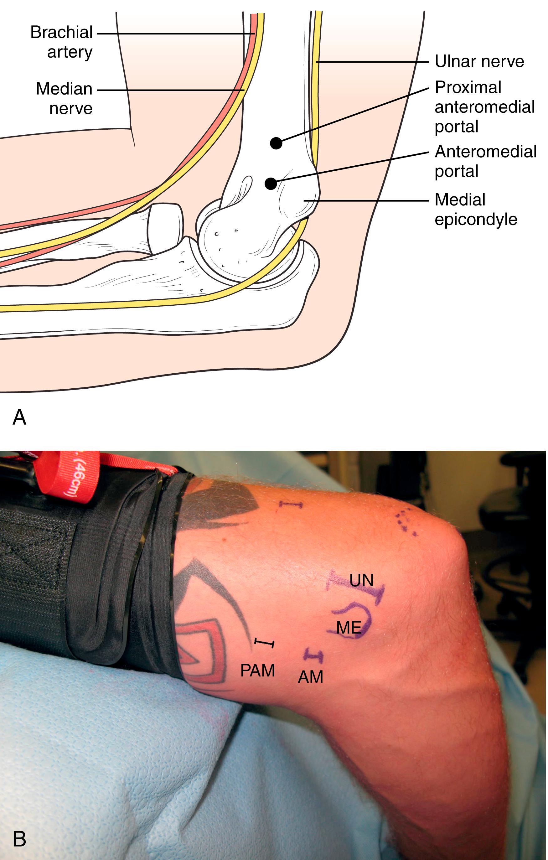 Fig. 26.5, A medical illustration (A) and intraoperative markings (B) on a right elbow in the lateral position depicting medial portals. AM, Anteromedial portal; ME, medial epicondyle; PAM, proximal anteromedial portal; UN, ulnar nerve.