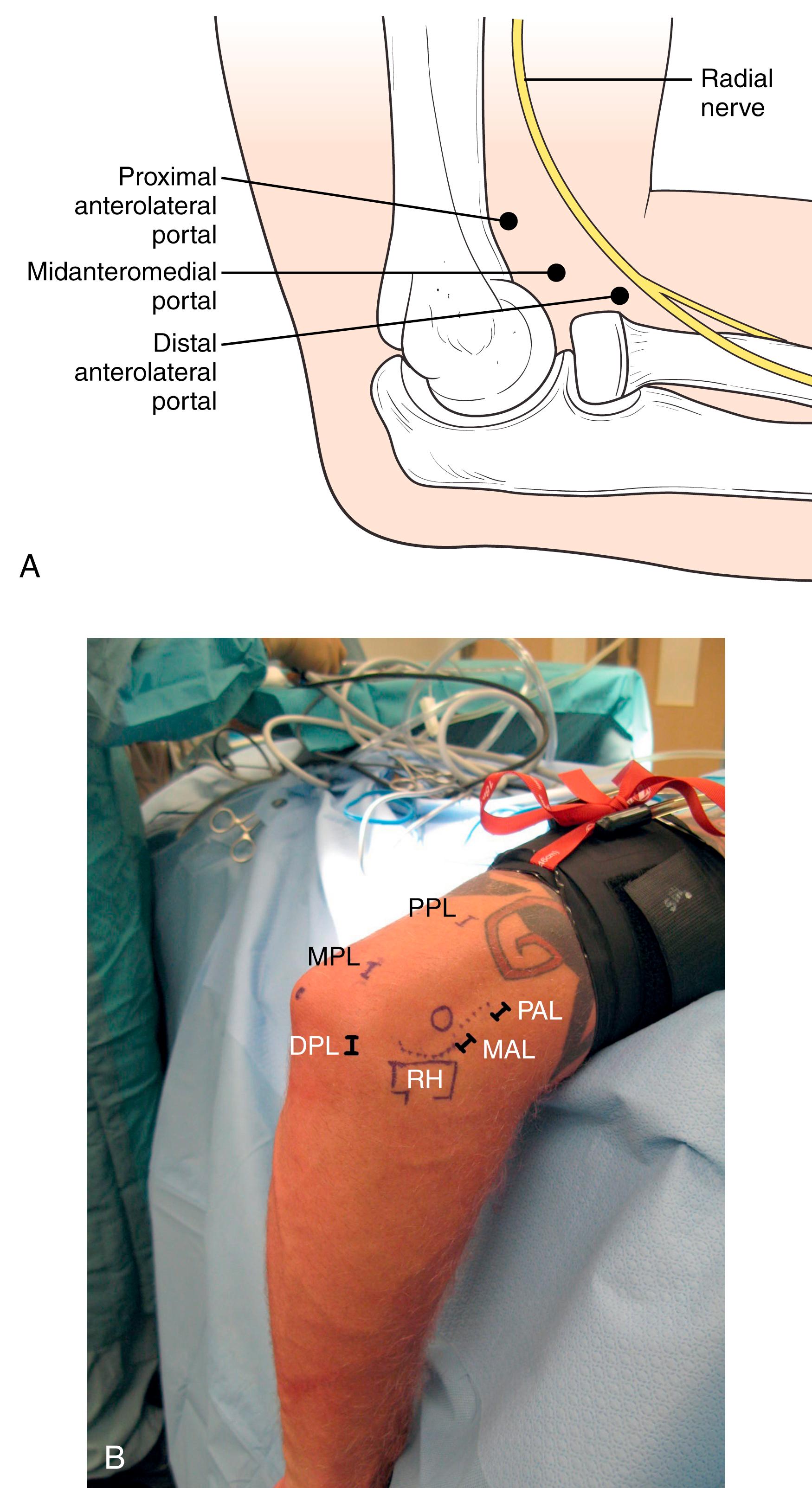 Fig. 26.6, A medical illustration (A) and intraoperative markings (B) on a right elbow in the lateral position depicting the lateral portals. DPL, Distal posterolateral portal; MAL, midanterolateral portal; MPL, midposterolateral portal; PAL, proximal anterolateral portal; PPL, proximal posterolateral portal; RH, radial head.