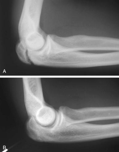 Fig. 58.1, An olecranon stress fracture. Radiographs of a college gymnast who presented with posterior elbow pain are shown. (A) The symptomatic side. (B) The contralateral extremity is shown for comparison.
